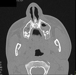 Facial and Orbital Trauma - CTisus CT Scan