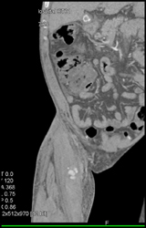 Bleed in Thigh S/P Stab Wound - CTisus CT Scan