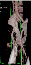 Active Extravasation S/P Stab Wound - CTisus CT Scan