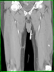 Active Bleed in Thigh S/P Stab Wound - CTisus CT Scan