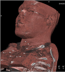 GSW With Fragments in Chest Wall - CTisus CT Scan