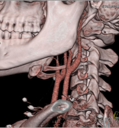 Carotid Arteries Not Injured - CTisus CT Scan