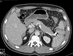 Splenic Laceration - CTisus CT Scan