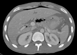 Perforated Bowel With Hemoperitoneum - CTisus CT Scan