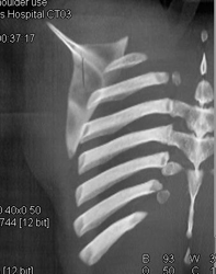 Scapular Fracture - CTisus CT Scan