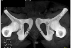 Pelvic Fractures - CTisus CT Scan