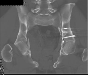 Repair of Acetabular Fracture - CTisus CT Scan