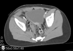 Stab Wound in Right Groin Without Vascular Injury - CTisus CT Scan