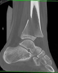 Comminuted Tibial Fracture Involves the Epiphysis - CTisus CT Scan