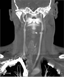 Gun Shot Wound With Tear in Carotid Artery - CTisus CT Scan