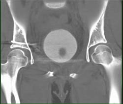 Repair of Pelvic Fracture and Dislocation - CTisus CT Scan