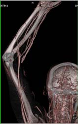 Ulceration of Arm Without Abscess - CTisus CT Scan