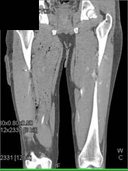 Gun Shot Wound With Soft Tissue But No Vascular Injury - CTisus CT Scan