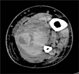 Calf Hematoma - CTisus CT Scan