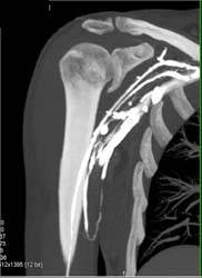 Opacification of Axillary Artery and Vein - CTisus CT Scan