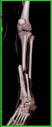 Tibial and Fibular Fracture - CTisus CT Scan