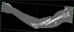 Humerus Fracture S/P Gun Shot Wound - CTisus CT Scan