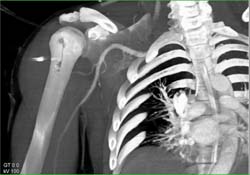 Humerus Fracture S/P Gun Shot Wound Without Vascular Injury - CTisus CT Scan