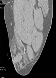 Gun Shot Wound in Thigh With Bleed and Active Extravasation - CTisus CT Scan