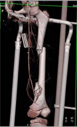 Fracture of the Femur in Fixation Device - CTisus CT Scan