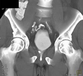 Pelvic Fracture With Urethral Injury - CTisus CT Scan