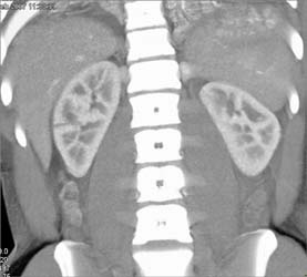 Renal Laceration - CTisus CT Scan