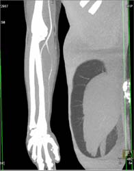 Spasm Radial Artery S/P Stab Wound - CTisus CT Scan