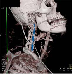 Contrast Extravasation From Carotid Due to Gun Shot Wound - CTisus CT Scan