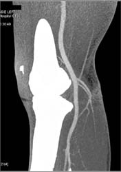 Normal Popliteal Artery - CTisus CT Scan