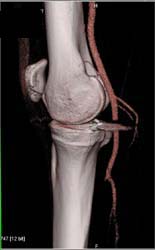 Artifact Due to Bullet Simulates Vascular Injury - CTisus CT Scan