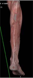 Gun Shot Wound to Calf With Vascular Injury - CTisus CT Scan