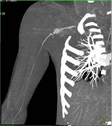 Injury to Axillary Artery S/P Stab Wound - CTisus CT Scan