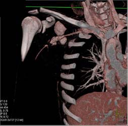 Active Bleed in Axilla - CTisus CT Scan