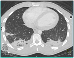 Pulmonary Contusion and Right Renal Laceration - CTisus CT Scan