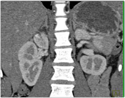 Subtle Renal Laceration - CTisus CT Scan