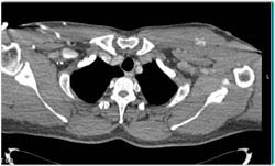 Bleed in Left Pectoralis Major Muscle S/P Stab Wound - CTisus CT Scan