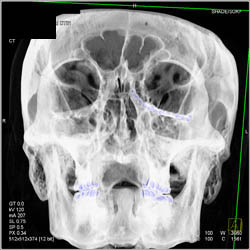 Orbital Fractures With Repair in 3D - CTisus CT Scan