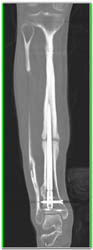 Non Union Tibia - CTisus CT Scan