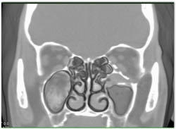 Repair of Orbital Fracture - CTisus CT Scan