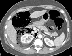 Perforation S/P ERCP With Air Near Duodenum and Kidney - CTisus CT Scan