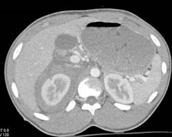 Renal Laceration and Bleed - CTisus CT Scan