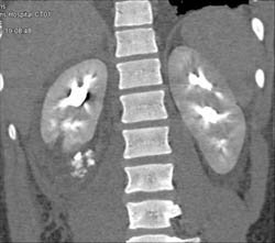 Contrast Extravasation Seen on Excretory Phase Images - CTisus CT Scan