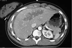 Hepatic Laceration and Hemoperitoneum - CTisus CT Scan