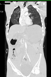 Pulmonary Contusion and Pneumothorax - CTisus CT Scan