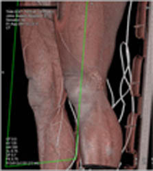 Laceration Thigh Without Vascular Injury - CTisus CT Scan