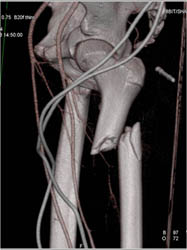 Femur Fracture Without Vascular Injury - CTisus CT Scan