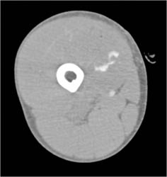 Active Bleed S/P GSW Thigh- CTA - CTisus CT Scan