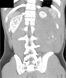 Perirenal Bleed S/P Stab Wound - CTisus CT Scan