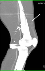 GSW With Femur Fracture. Artifact Makes It Hard to Evaluate Distal SFA & Popliteal Artery But No Active Extravasation of Contrast Seen - CTisus CT Scan