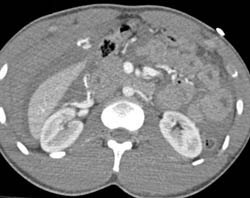 Hepatic Laceration With Bleed and Hemoperitoneum - CTisus CT Scan